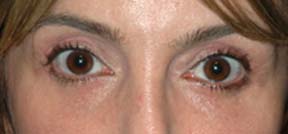 Eye Lift - Patient 2 - After